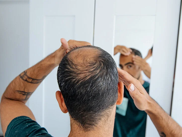 Noticing Male Pattern Baldness? What to Consider Doing