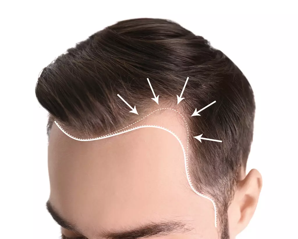 Noticing Male Pattern Baldness? What to Consider Doing
